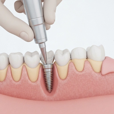 Detailed illustration of a dental implant being placed into the jawbone